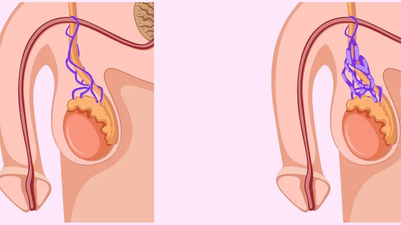 Giãn tĩnh mạch làm tăng nhiệt độ vùng bìu, ảnh hưởng trực tiếp đến khả năng sinh sản
