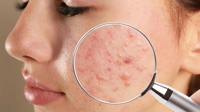 Nếu tình trạng mụn hoặc sẹo diễn biến phức tạp, Bạn nên đến gặp bác sĩ da liễu để được soi da và tư vấn phác đồ phối hợp 