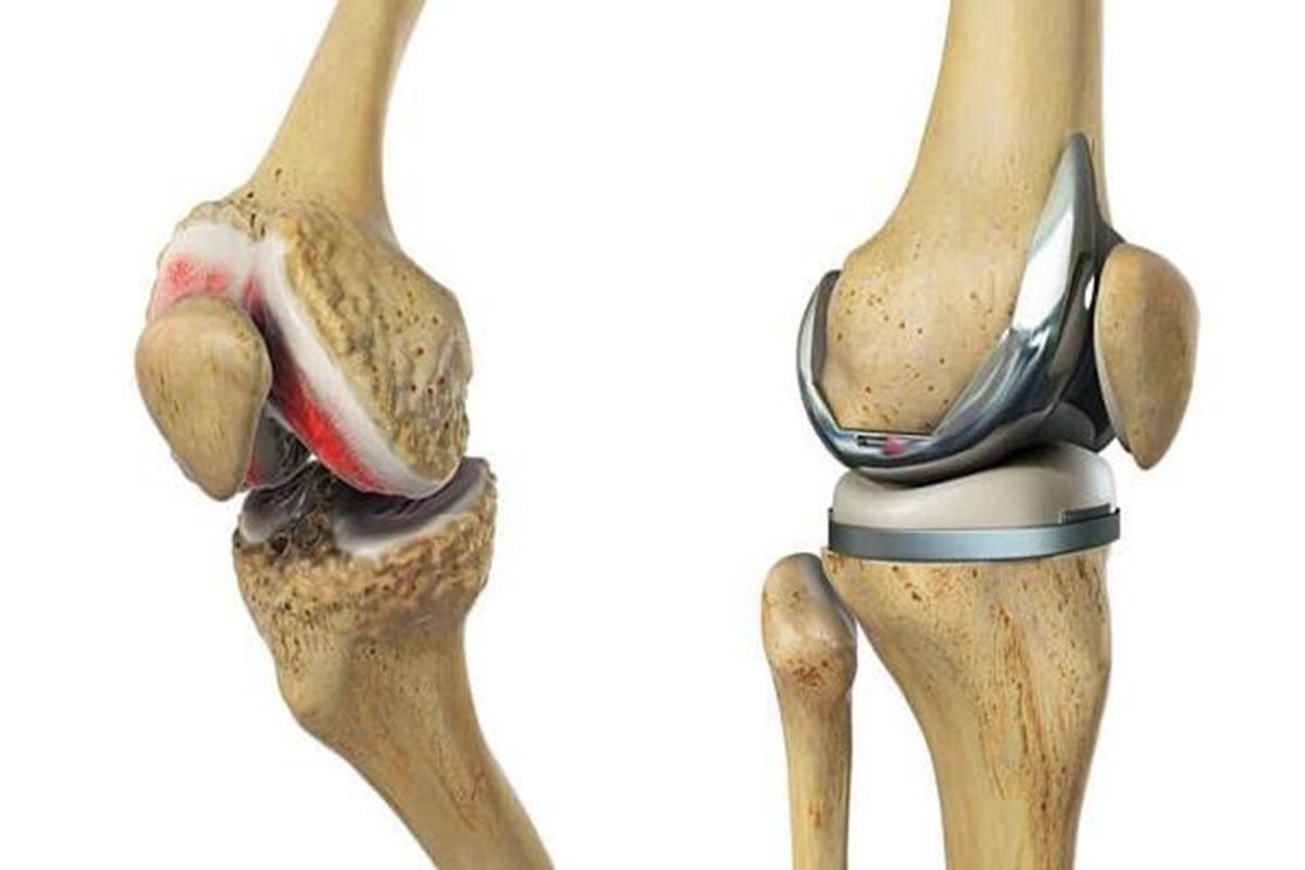 THAY KHỚP GỐI TẠI BỆNH VIỆN UY TÍN GIÚP PHỤC HỒI VẬN ĐỘNG HIỆU QUẢ