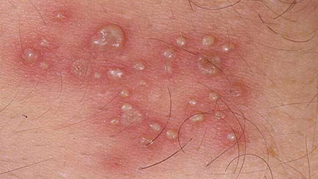 Một số trường hợp sưng bao quy đầu có thể kèm theo đỏ và đau