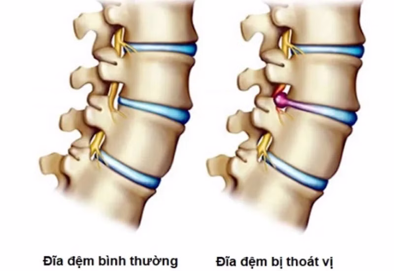Các bệnh lý cột sống có thể gây đau lưng và hạn chế vận động