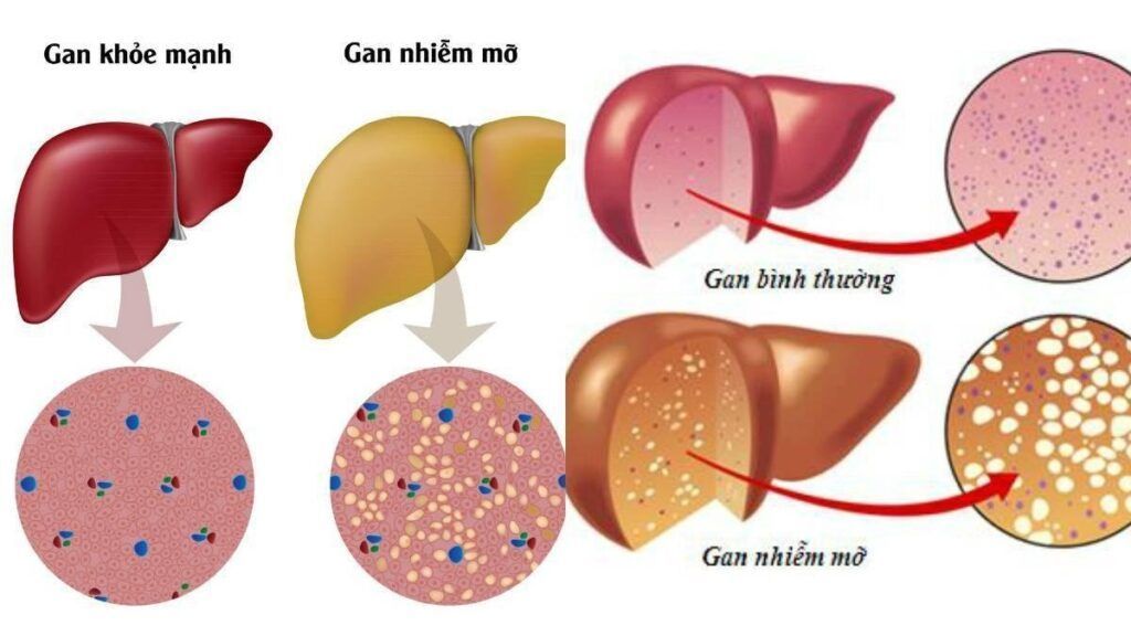 Hạn chế thực phẩm nhiều đường giúp gan phục hồi rạng rỡ và bền bỉ 