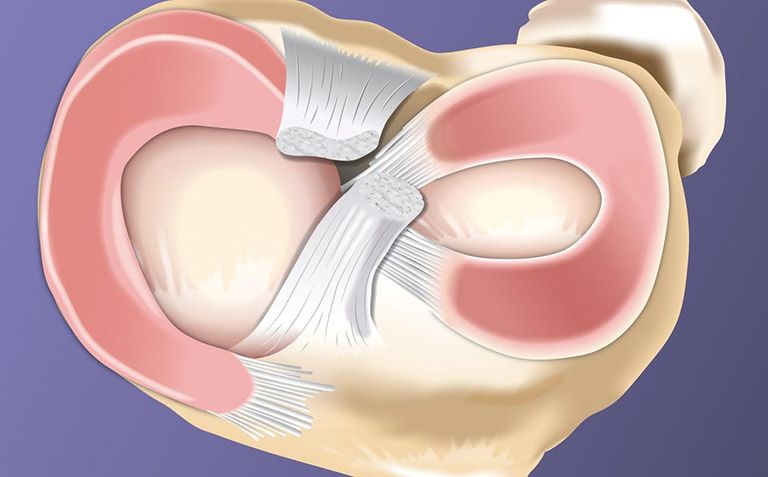 Hình minh họa cấu trúc sụn chêm trong khớp gối và vị trí có thể xảy ra rách sụn chêm đầu gối