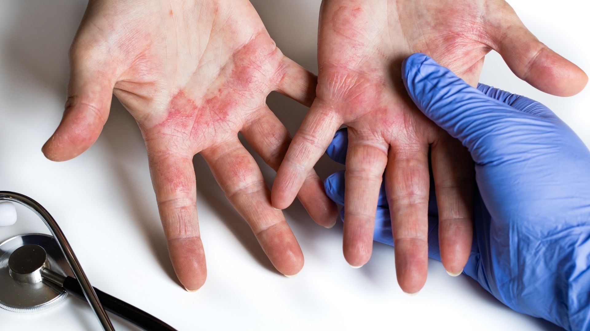 Viêm da tiếp xúc gây đỏ, sưng, mụn nước, rỉ dịch và ngứa rát.