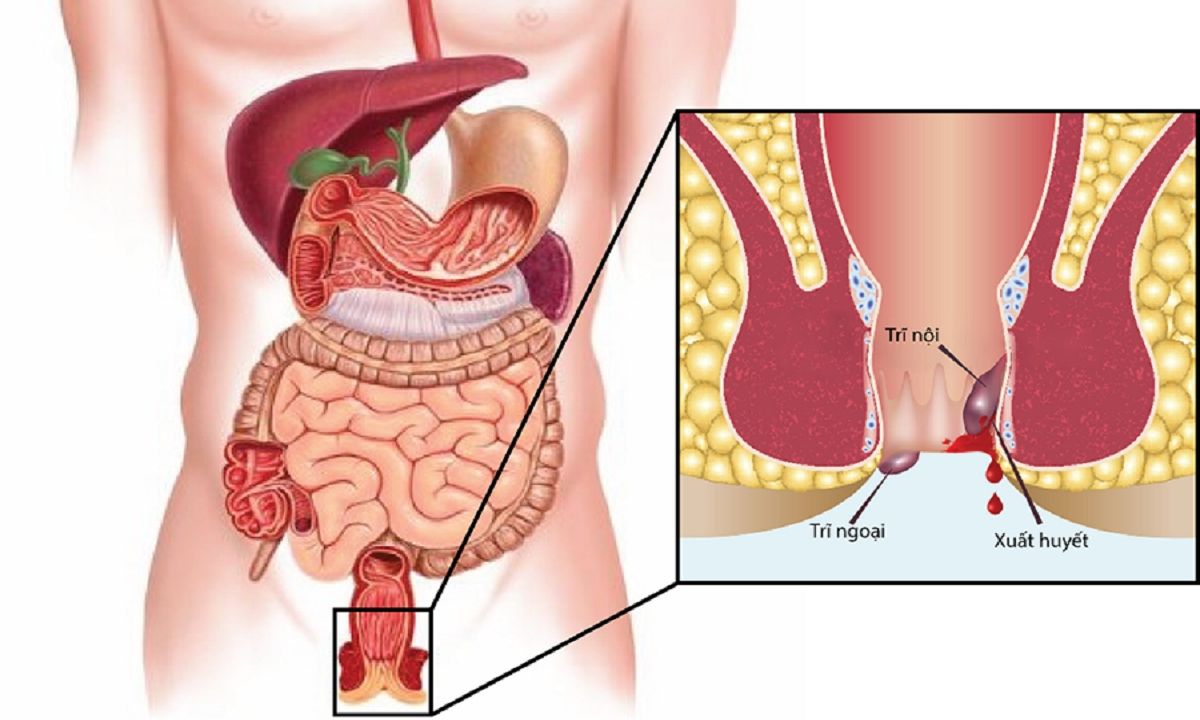 Giữ vệ sinh hậu môn đúng cách là chìa khóa để ngăn ngừa ngứa rát