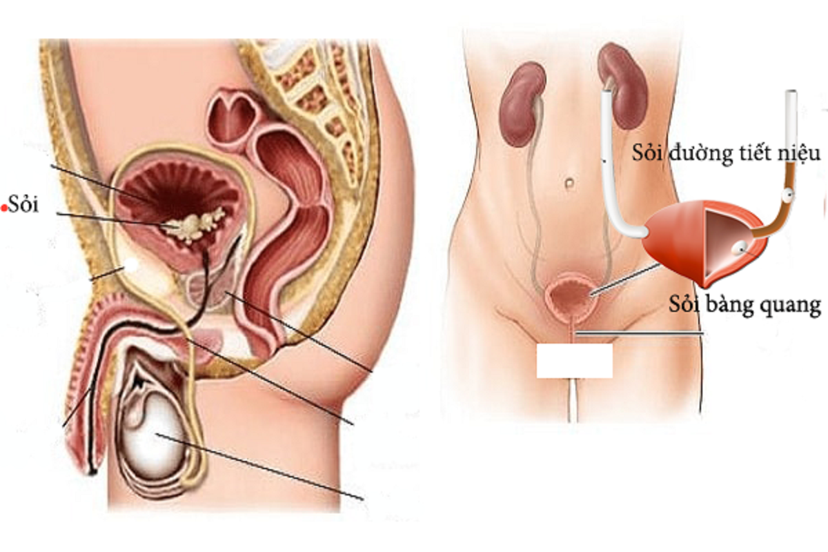 Hình minh họa phát hiện bệnh lý qua nội soi bàng quang