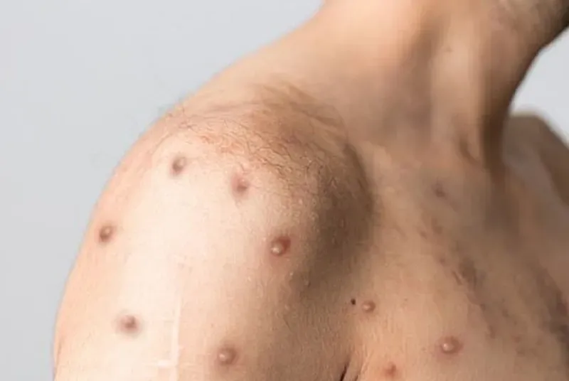 Tình trạng mụn kèm theo mệt mỏi kéo dài có thể là tín hiệu cảnh báo từ hệ miễn dịch 