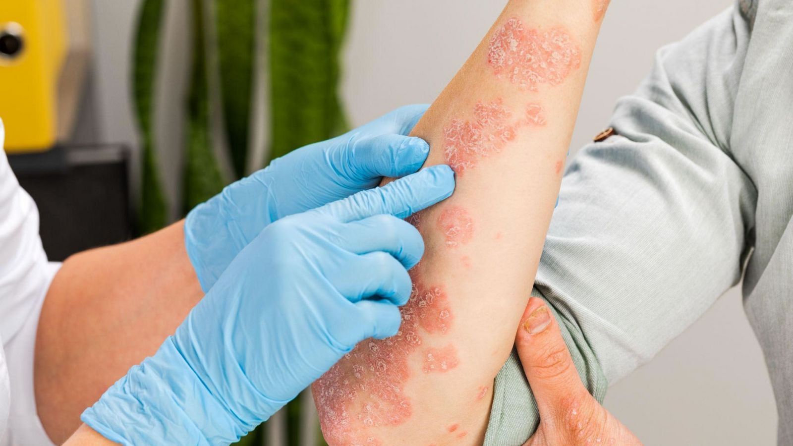 Tổn thương da giai đoạn mạn tính với biểu hiện khô ráp, bong vảy và lichen hóa dày sừng 