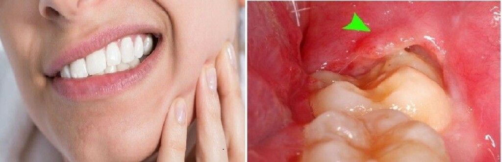 Mọc răng khôn có thể gây sưng và viêm lợi ở vùng hàm dưới.