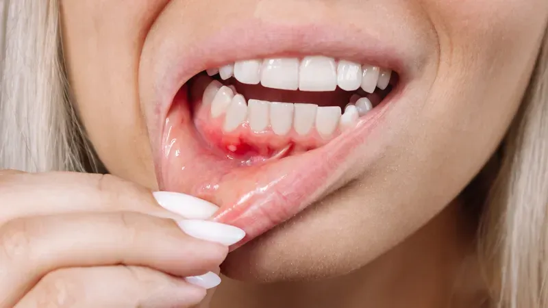 Cần tìm hiểu kỹ quan hệ bằng miệng có lây viêm gan B không để bảo vệ sức khỏe