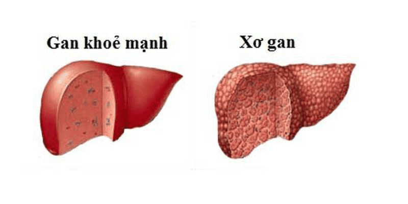 Minh hoạ về tình trạng xơ gan