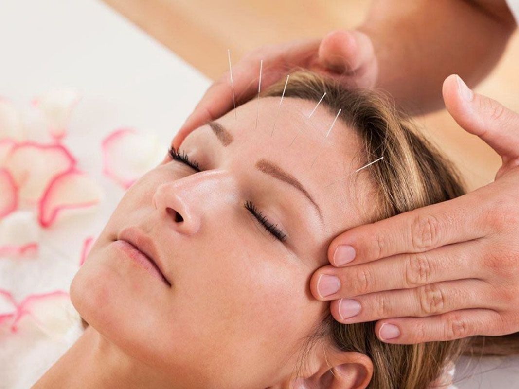 Kiên trì thực hiện đúng liệu trình châm cứu là chìa khóa để vượt qua bệnh liệt mặt 