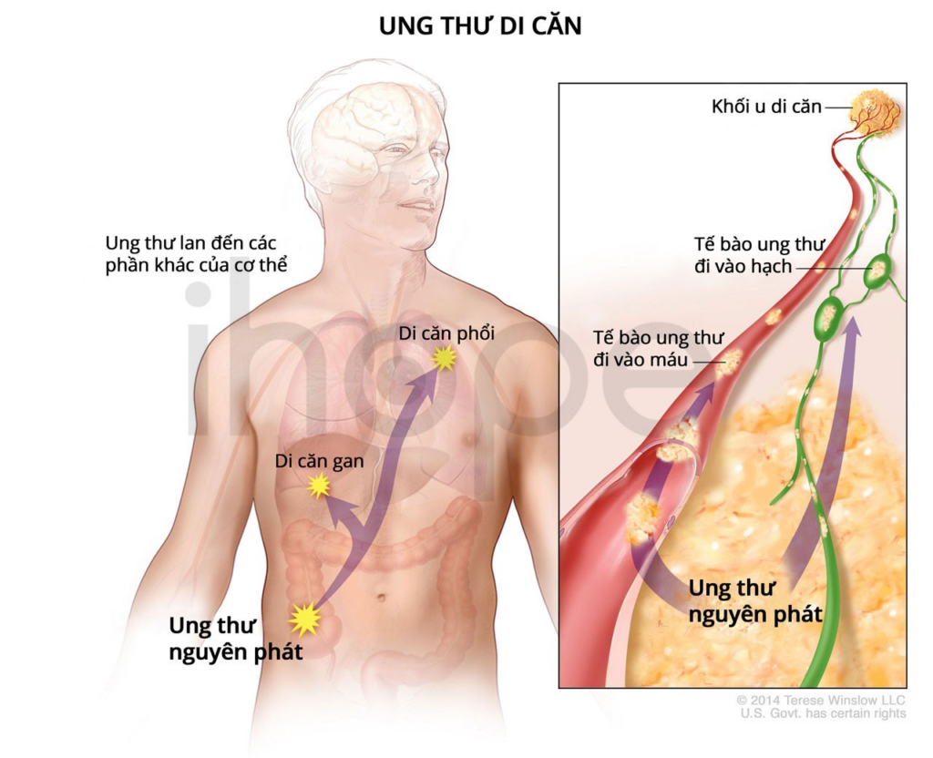 Minh hoạ về tuyến tiền liệt