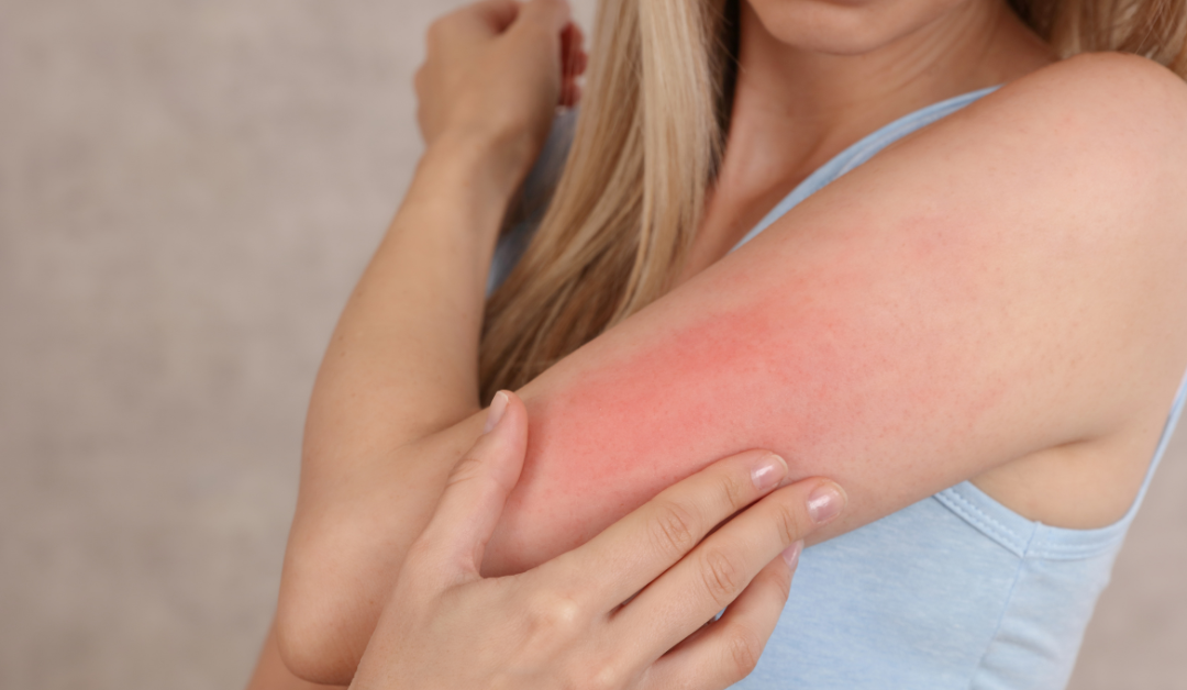 Tránh xa các dị nguyên là nguyên tắc vàng giúp điều trị dị ứng tận gốc
