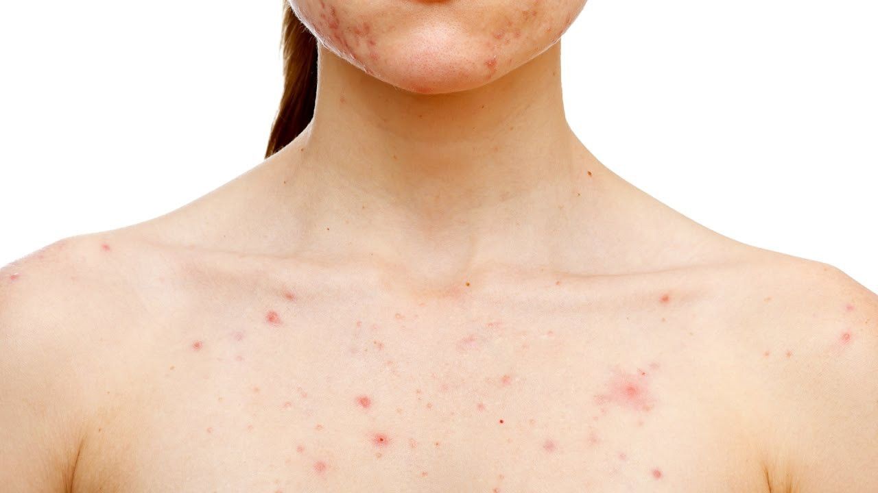 Chăm sóc và giữ ẩm da có thể giúp giảm cảm giác ngứa và kích ứng