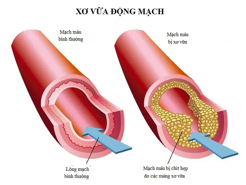 Dinh dưỡng đóng vai trò tiên quyết trong việc làm chậm tiến triển của mảng xơ vữa và bảo vệ trái tim khỏi các biến cố nguy hiểm