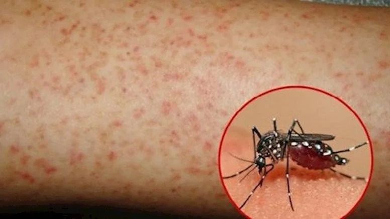 Khi xuất hiện các dấu hiệu cảnh báo chuyển nặng, người bệnh cần được đưa đến cơ sở y tế ngay lập tức 