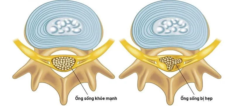 X-quang giúp phát hiện các thay đổi về cấu trúc xương như gai xương hẹp của ống sống
