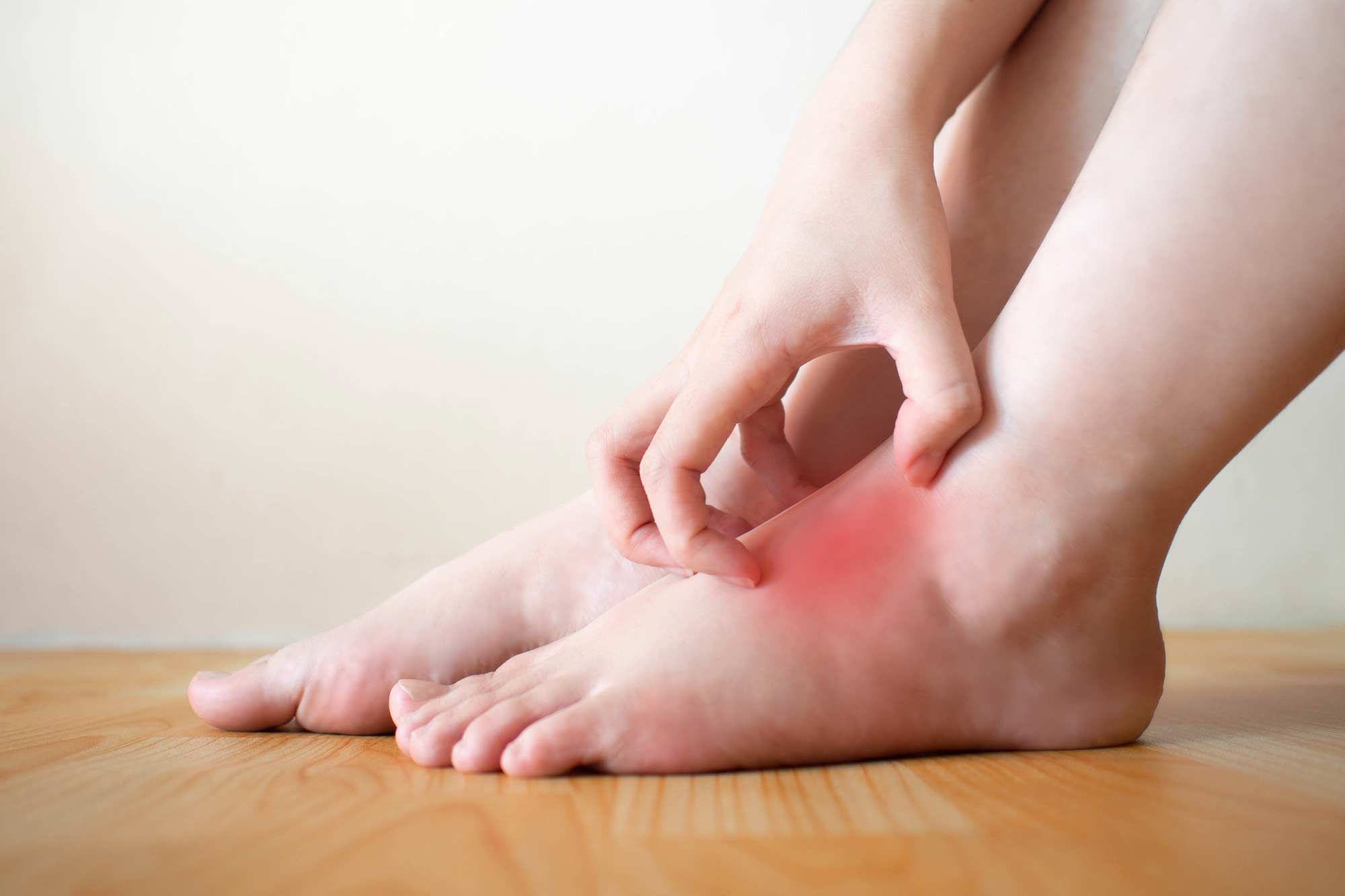 Nhiễm nấm là nguyên nhân hàng đầu gây ngứa và bong tróc da chân 