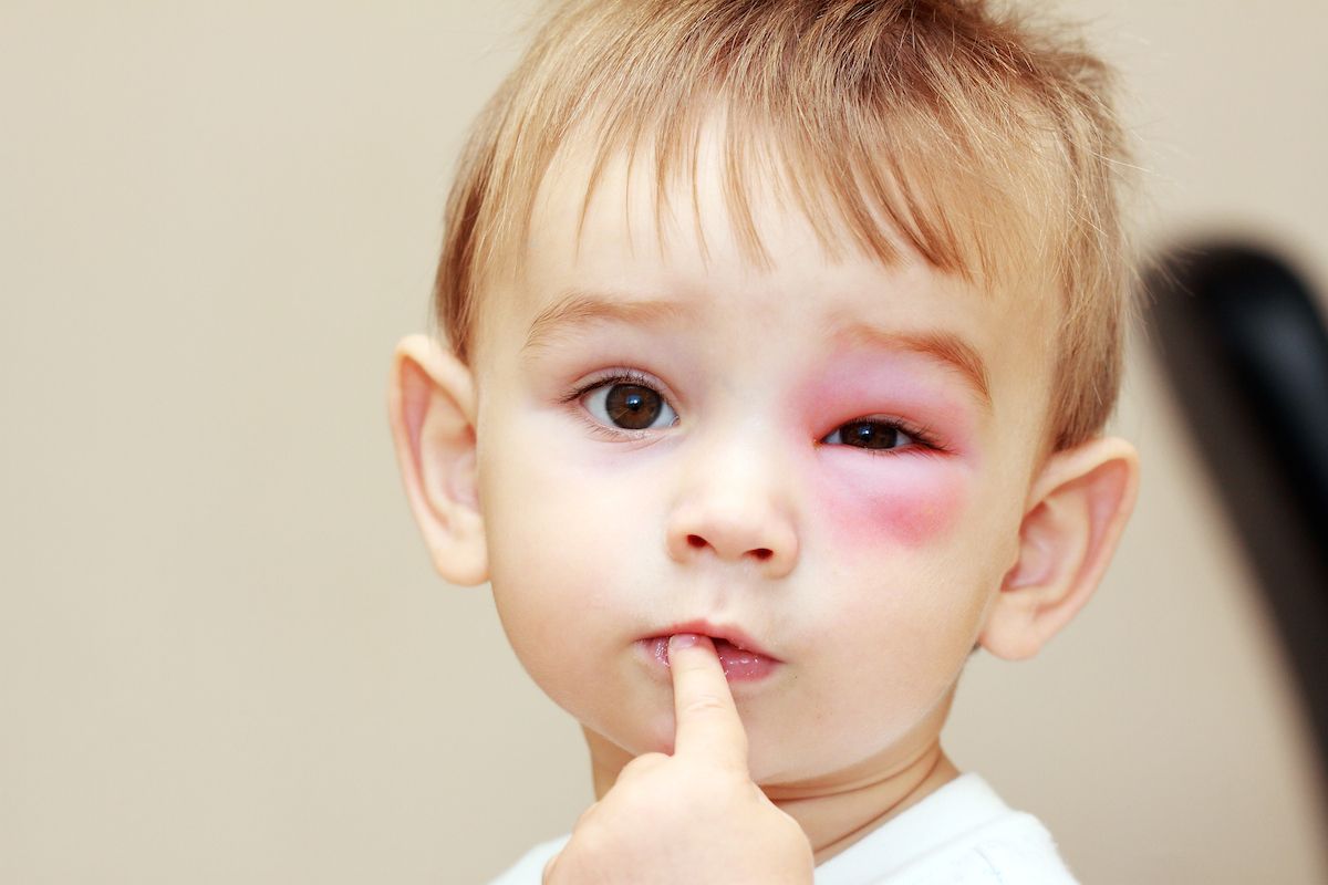 Chườm lạnh và chăm sóc đúng cách giúp giảm sưng và làm dịu vết côn trùng cắn Chườm lạnh là biện pháp đơn giản nhưng mang lại hiệu quả cao trong việc giảm sưng và giảm cảm giác ngứa. Bạn có thể dùng đá lạnh bọc trong khăn sạch và chườm lên vùng da bị cắn trong khoảng 10–15 phút, lặp lại vài lần trong ngày nếu cần. Ngoài ra, việc giữ vùng da bị cắn sạch sẽ, khô ráo và tránh gãi là rất quan trọng. Gãi không chỉ làm tổn thương da mà còn tạo điều kiện cho vi khuẩn xâm nhập, làm tăng nguy cơ nhiễm trùng. Trong quá trình chăm sóc, bạn nên theo dõi diễn tiến của vết cắn. Nếu nhận thấy dấu hiệu bất thường như sưng lan rộng, đau nhiều hoặc xuất hiện mủ, cần thăm khám để được tư vấn phù hợp.