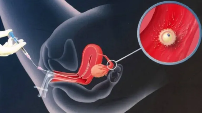 IUI phương pháp bơm tinh trùng vào buồng tử cung