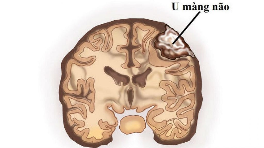 Các phương pháp chẩn đoán hình ảnh giúp phát hiện và đánh giá mức độ giãn não thất