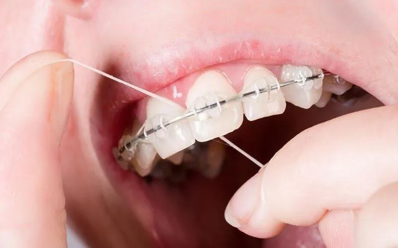 Hướng dẫn sử dụng chỉ nha khoa đúng cách cho người niềng răng để bảo vệ