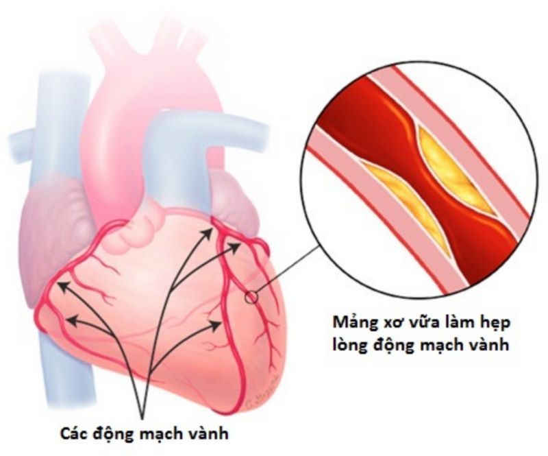 Chế độ ăn giàu rau xanh và hoa quả là liều thuốc tự nhiên tốt nhất cho mạch máu của bạn - Phòng ngừa hẹp mạch vành