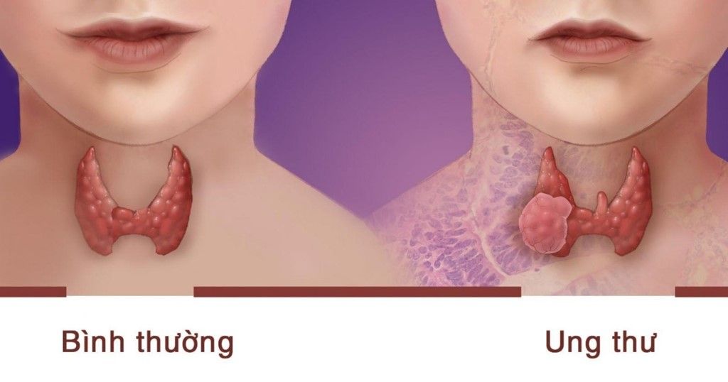 Việc thăm khám sớm giúp xác định chính xác nguyên nhân gây bệnh lý tuyến giáp 