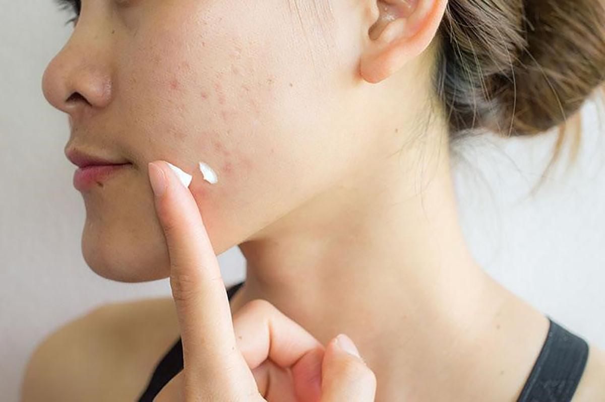 Mỹ phẩm kém chất lượng hoặc chứa thành phần kích ứng là nguyên nhân hàng đầu gây dị ứng mặt