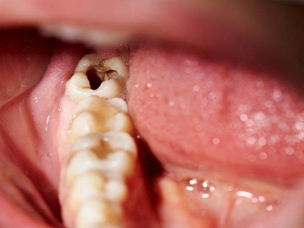 Ê buốt răng thường xảy ra khi men răng bị mòn hoặc lộ ngà răng