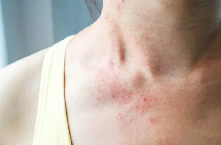 Tình trạng sẩn ngứa