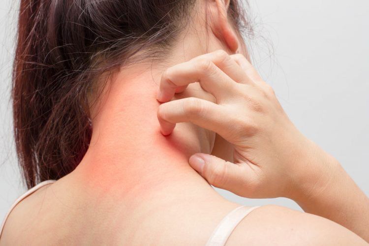 Minh họa về tình trạng ngứa ngáy mẫn đỏ do mề đay gây ra