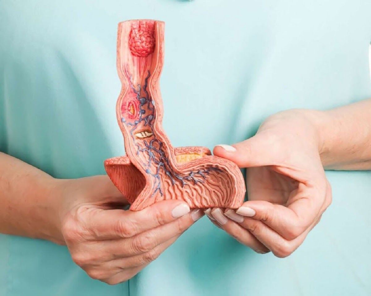 Ợ nóng và ợ chua là những triệu chứng phổ biến của trào ngược dạ dày