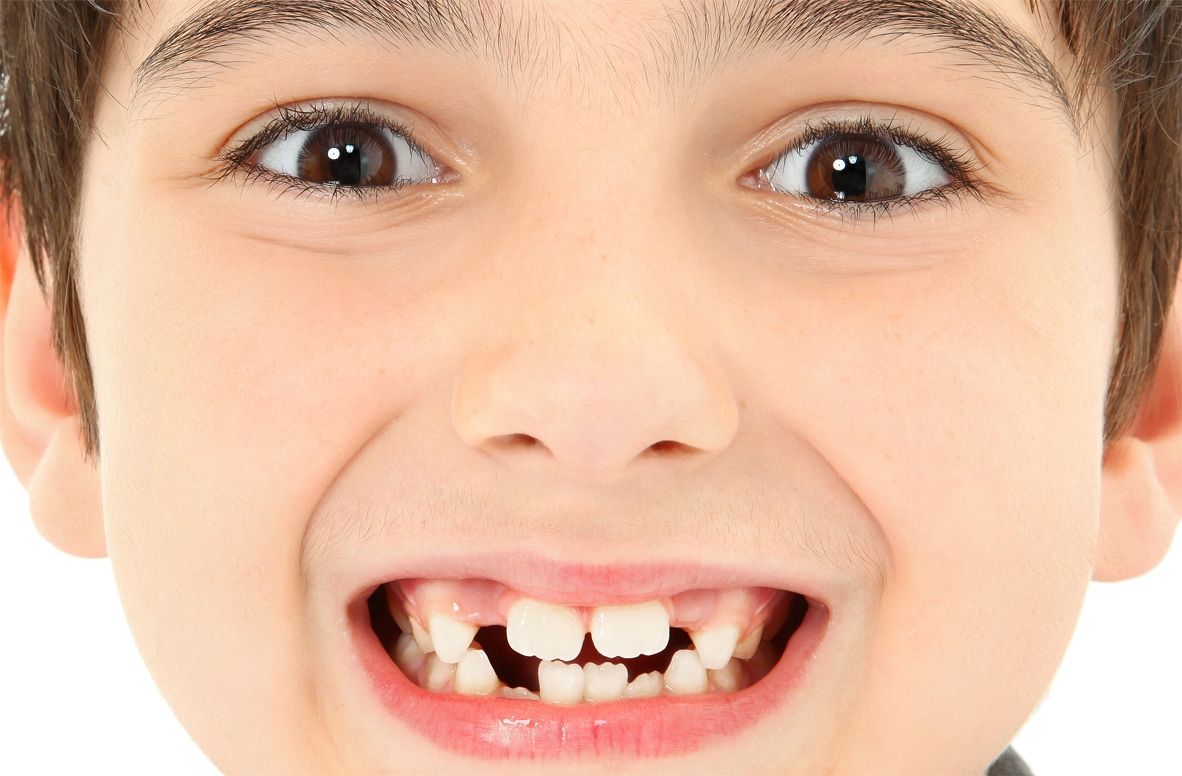 Các bệnh lý răng miệng có thể khiến hạch dưới cằm sưng to.