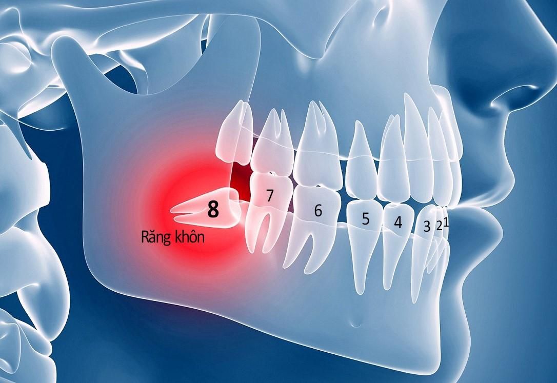 Sưng lợi hàm dưới có thể gây đau nhức và khó chịu khi ăn nhai.