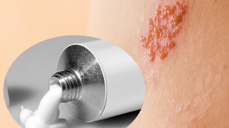 Thoa thuốc bôi zona đúng cách giúp làm dịu cảm giác đau rát tại các vùng sẩn đỏ ngoại biên