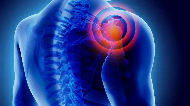 Rách sụn viền khớp vai: nguyên nhân, triệu chứng và cách điều trị hiệu quả