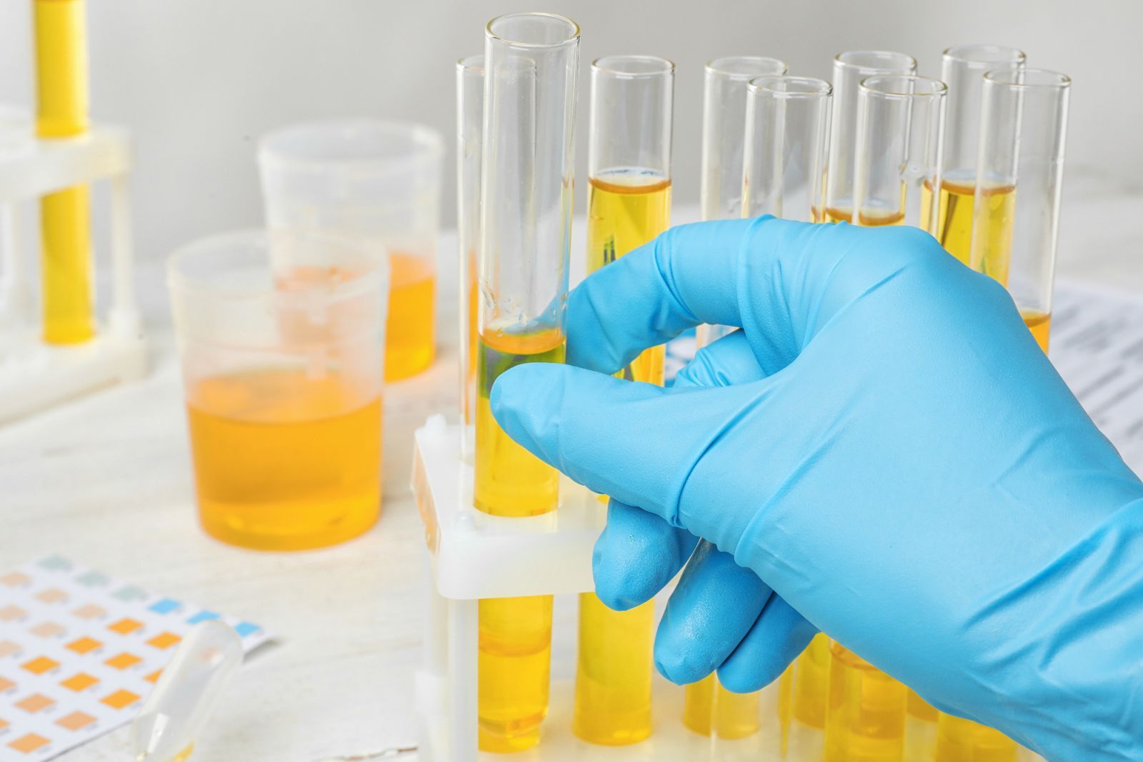 Bệnh lý về thận là nguyên nhân hàng đầu dẫn đến sự xuất hiện của protein và bọt trong nước tiểu 