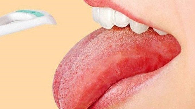 Hình minh họa nổi mụn ở lưỡi ( Nguồn: Sưu tầm )