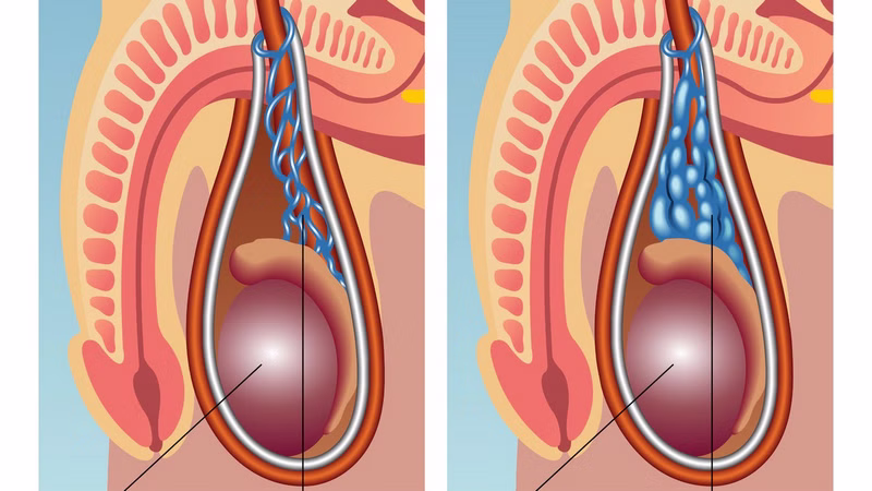 Siêu âm bìu giúp chẩn đoán và đánh giá mức độ giãn tĩnh mạch thừng tinh