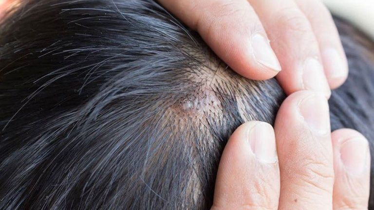 Nổi mụn trên đầu có thể gây ngứa hoặc đau khi chạm vào