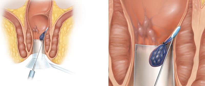 Sự phát triển của y học giúp quá trình phẫu thuật trĩ diễn ra nhẹ nhàng và ít đau đớn hơn 