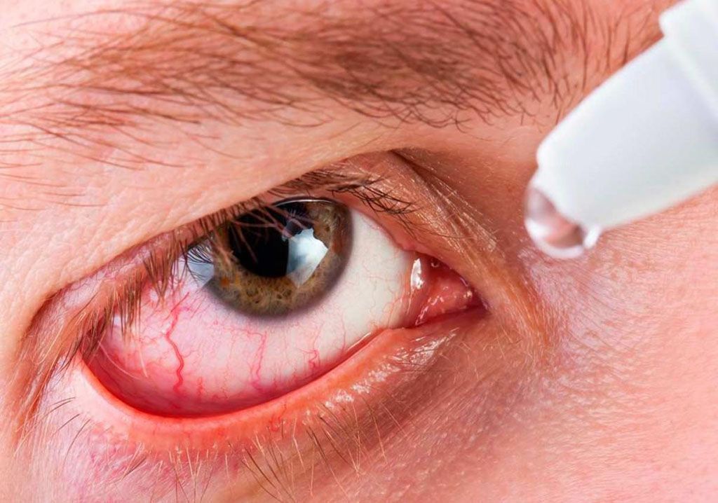 Dị ứng và các bệnh lý về mắt là nguyên nhân phổ biến khiến càng dụi mắt càng ngứa