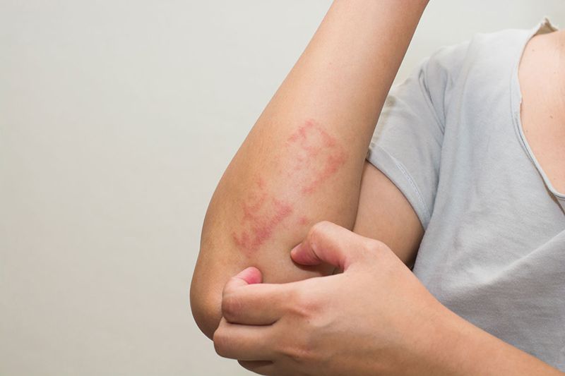 Ngưng dùng thuốc ngay nếu gặp phản ứng dị ứng, quá mẫn 