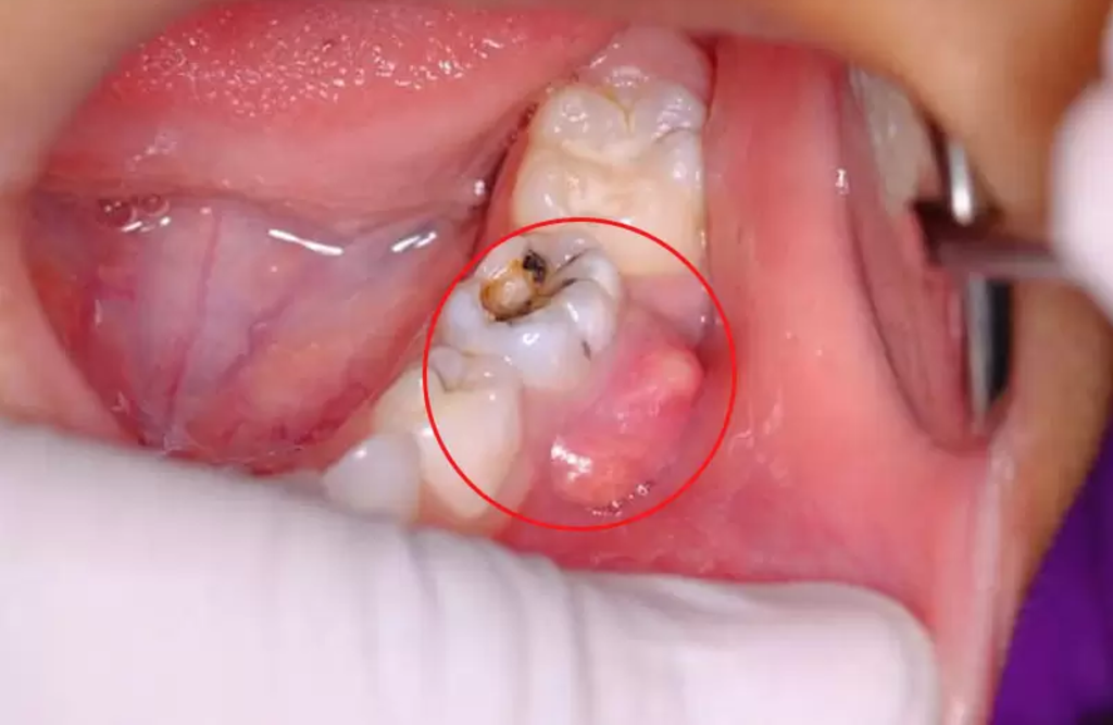 Vệ sinh răng miệng đúng cách giúp giảm nguy cơ viêm và sưng lợi.