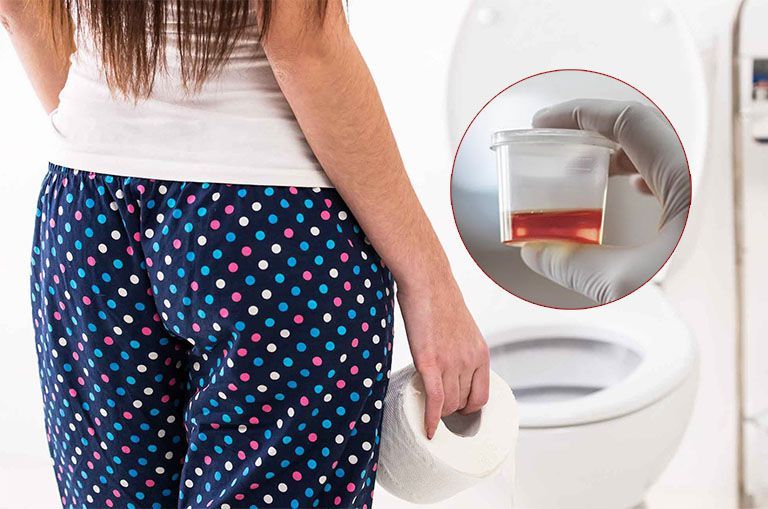 Nước tiểu màu nâu đỏ có thể phản ánh sự hiện diện của máu đã bị oxy hóa hoặc sắc tố mật 