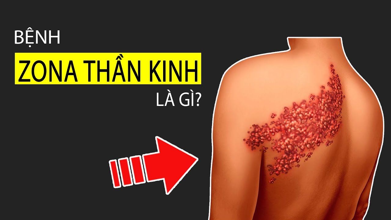 Hiểu rõ cơ chế tổn thương thần kinh giúp người bệnh phối hợp tốt hơn trong quá trình điều trị dài hạn