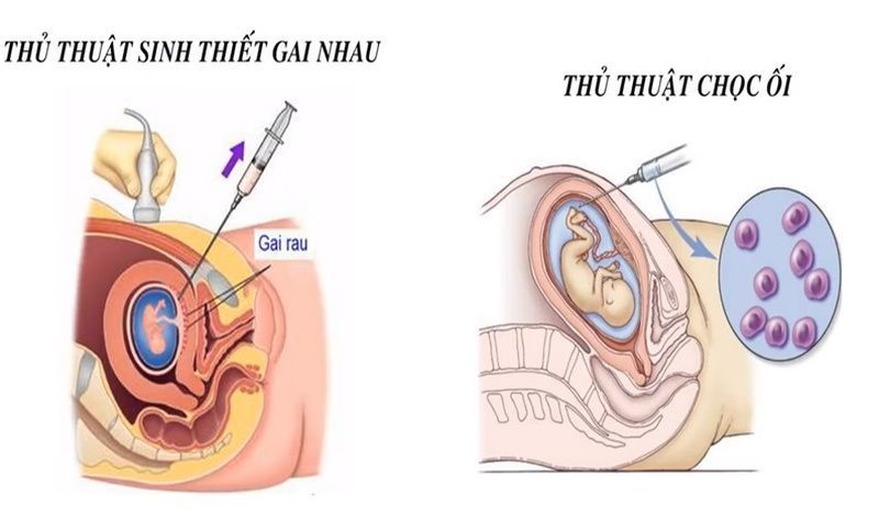 Chọc ối và sinh thiết gai rau 