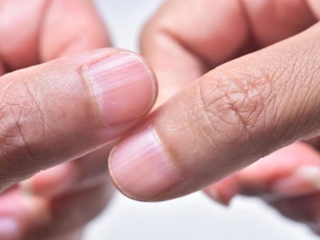 Nguyên nhân và cách nhận biết móng tay có sọc trắng dọc – dấu hiệu cảnh báo